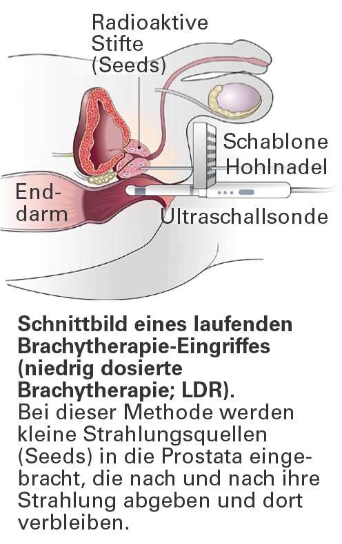 brachytherapie