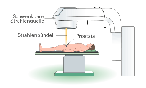 Mit einem Linearbeschleuniger kann ein Prostatatumor zielgenau bestrahlt und gesundes Gewebe weitgehend geschont werden.