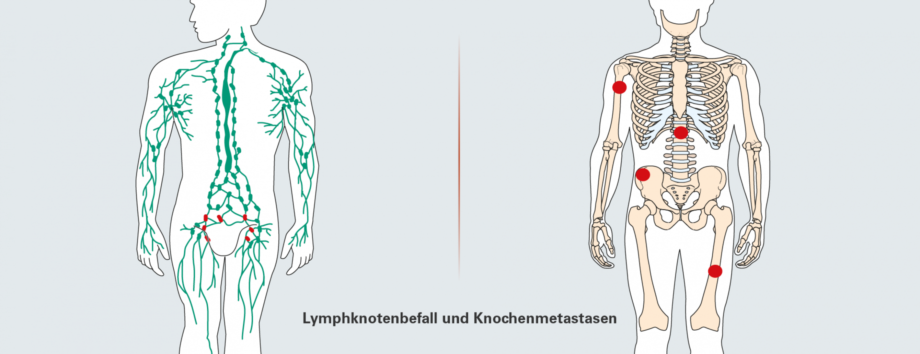 lymphknotenmetastasen prostatakarzinom